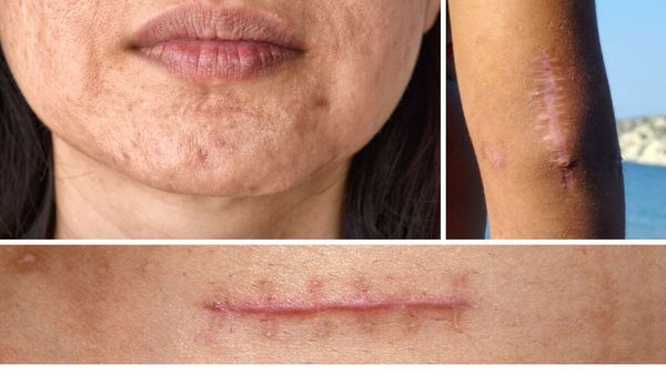 8 Essential Oils That Are Proven To Help Reduce The Appearance Of Scars!