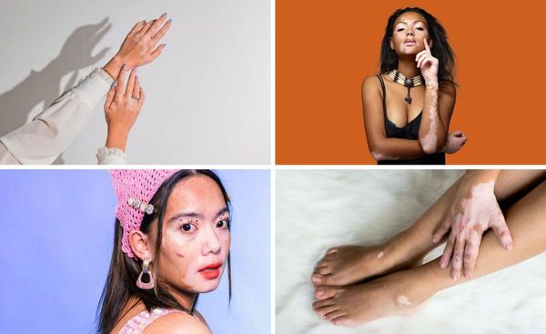 Sun Smart: Your Guide to the Best Sunscreen For Vitiligo Protection