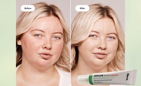 Redness, Begone! Hero Cosmetics Rescue Balm +Red Correct Gives You Even-Toned Skin in an Instant!